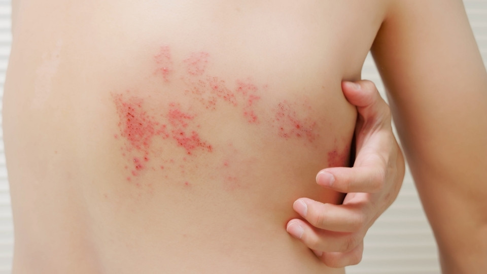 shingles vaccine